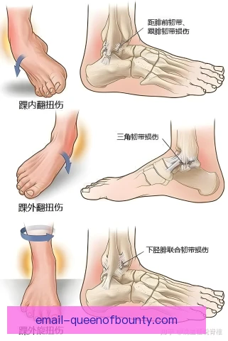 越野跑踝关节扭伤康复，分阶段训练恢复稳定